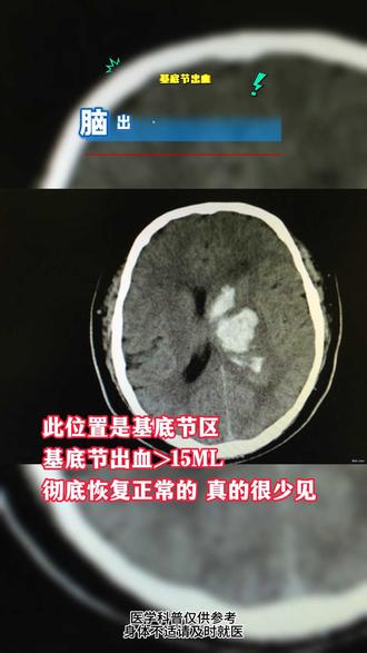 脑出血