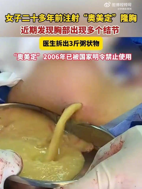 【#女子隆胸注射物20多年后变质】