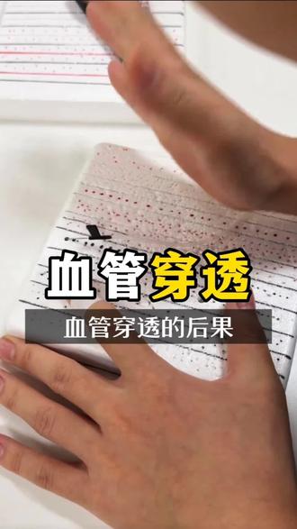 打针时你有没有想过 针头穿透血管的后果太