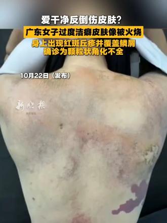 爱干净反倒伤皮肤？广东女子过度洁癖皮肤像被火烧，身上出现红斑丘疹并覆盖鳞屑，确诊为颗粒状角化不全。#