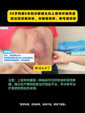 六旬老人背部患硬化性上皮样纤维肉瘤，拖延数年，已多发转移。