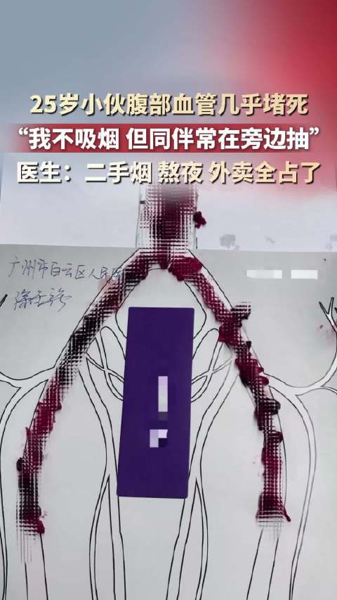 【#25岁小伙血管几乎堵死取出巨型血栓#】#男子长吸二手烟血管从肚子堵到腿# 10月14日（报道）。