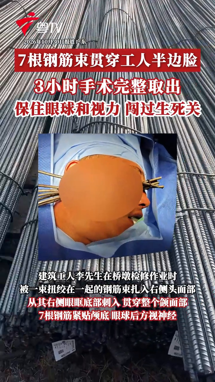 工人被7根钢筋束贯穿半边脸医院3小时取出
