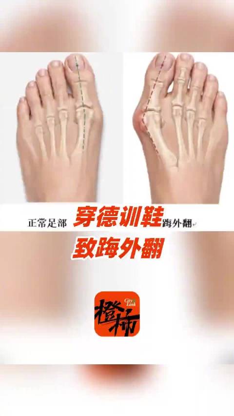 #第一批穿德训鞋的受害者出现了# 杭州32岁的应女士天生脚型宽大、脚背偏高