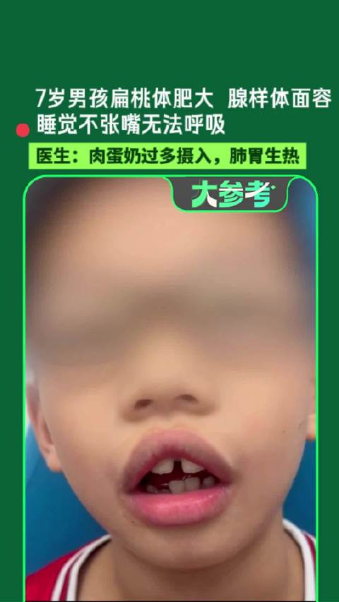 【#7岁男孩吃的太好出现腺样体面容#】河南一位7岁男孩睡觉不张嘴就没法呼吸，结果查出腺样体肥大、扁桃