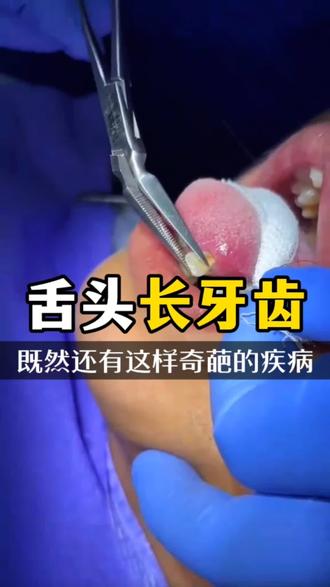 为什么有的人舌头上也能长牙齿