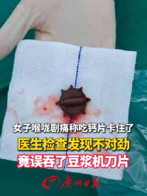 【#女子喉咙痛就医发现自己误吞刀片#】#女子称钙片卡嗓就医发现误吞刀片# 近日，云南大理。一女子因喉