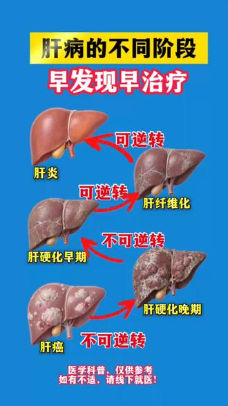 肝硬化
