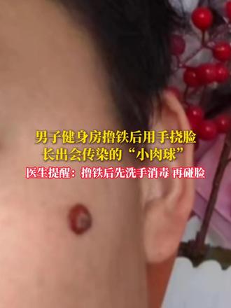 男子健身房撸铁后用手挠脸，长出会传染的“小肉球”， 医生提醒：撸铁后先洗手消毒 再碰脸
