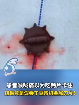患者喉咙痛以为吃钙片卡住，结果竟是误吞了豆浆机金属刀片！
