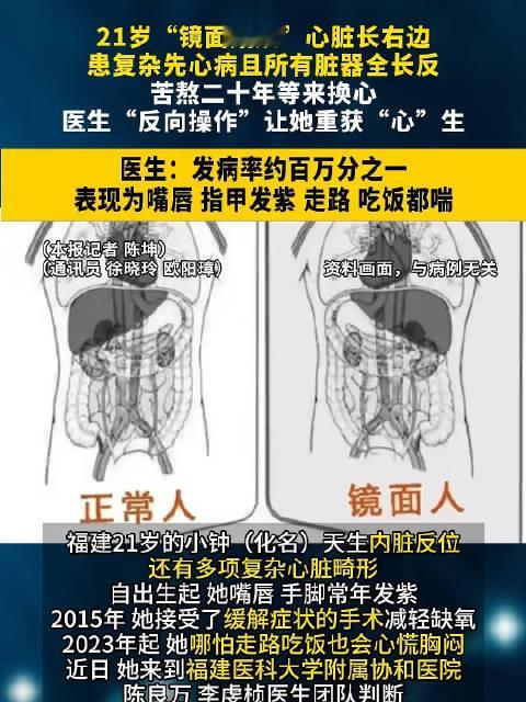 #21岁女生五脏六腑全长反#【#医生反着做手术为镜面人心脏移植#，在医护团队全程精细看护下，患者顺利