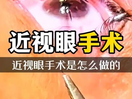近视眼激光手术究竟是怎做的