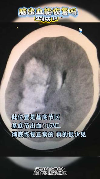 脑出血