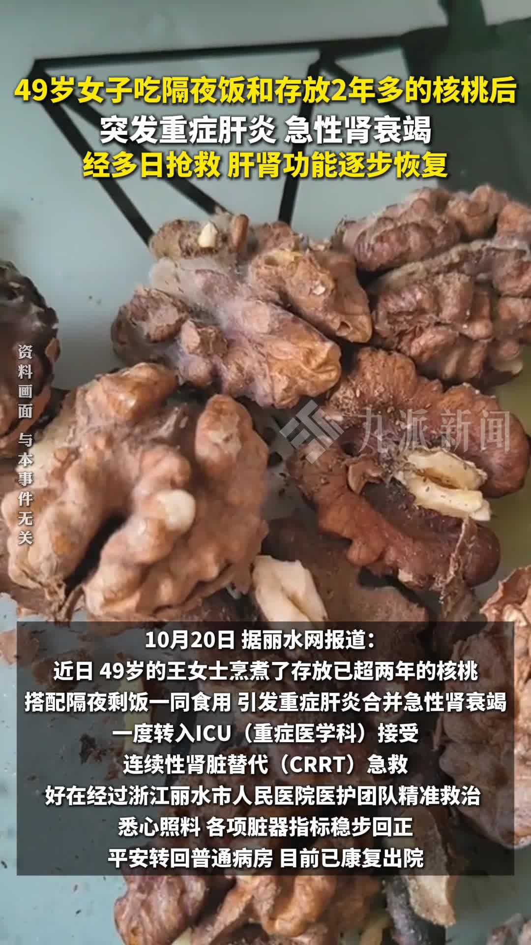 49岁女子吃隔夜饭和存放2年多的核桃后突发重症肝炎、急性肾衰竭，抢救后逐步恢复