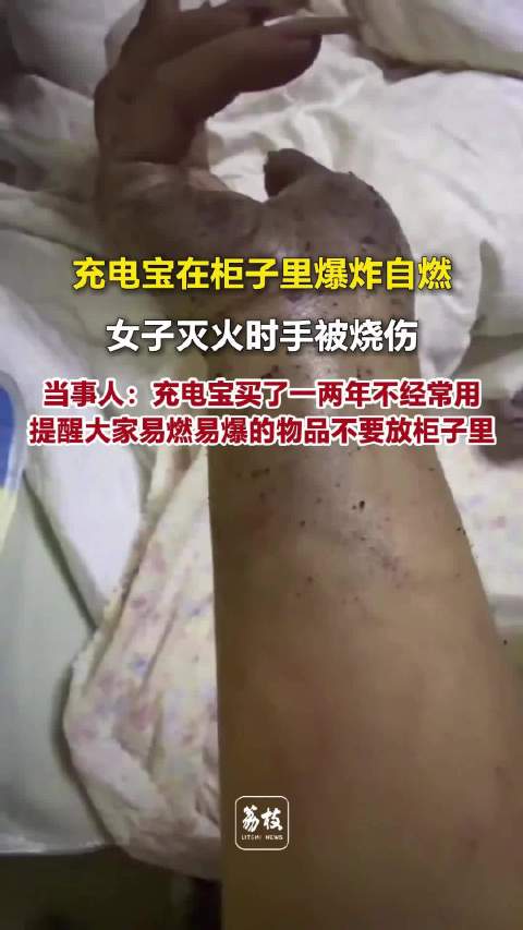 【#充电宝放衣柜自燃女子灭火被烧伤##女子回应充电宝放衣柜爆炸致烧伤】