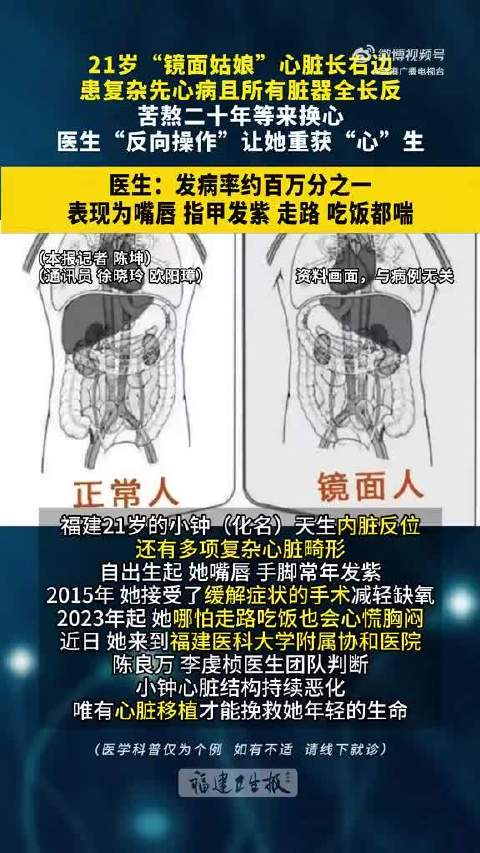 #镜面人发病率仅百万分之一#【#21岁镜面女孩心脏长在胸腔右侧#】福建一名21岁女孩是罕见的“镜面人