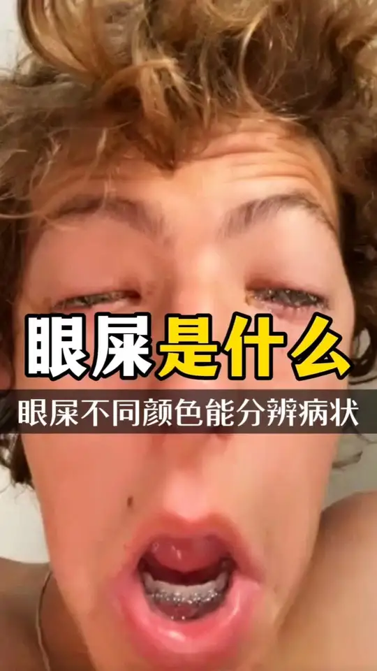眼屎到底是什么 不同的颜色还能分辨出不同的症状
