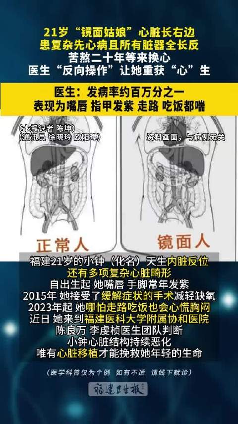 【#21岁女孩患复杂先心病且器官全长反# 】福建一名21岁女孩是罕见的“镜面人”，体内全部脏器位置和