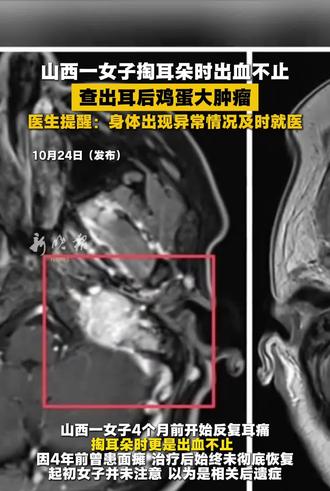山西一女子掏耳朵时出血不止，查出耳后鸡蛋大肿瘤，医生提醒:身体出现异常情况及时就医。#山西#肿瘤#面