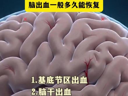 脑出血