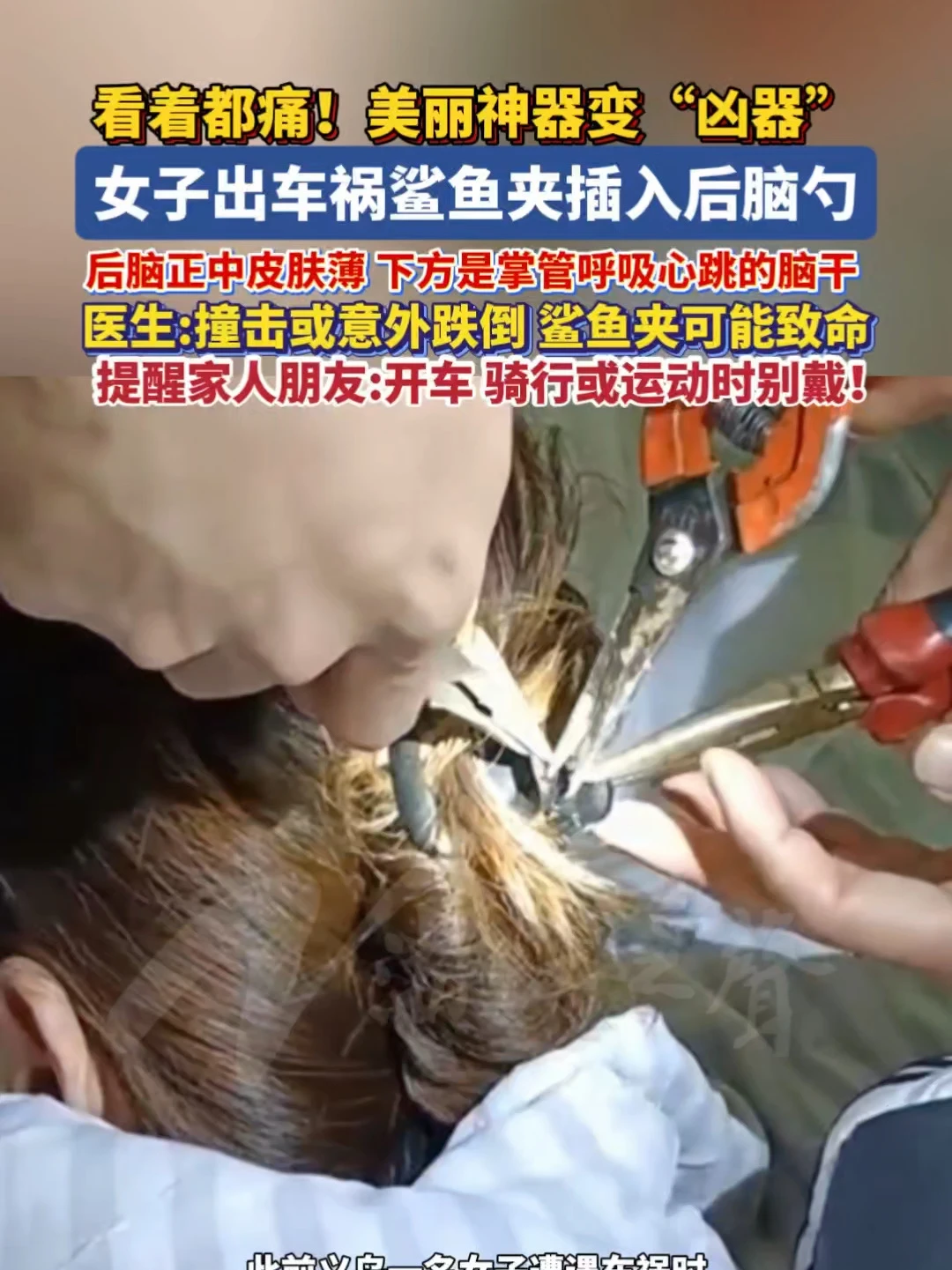 美丽神器变“凶器”！女子出车祸，鲨鱼夹插入后脑勺。医生：后脑正中皮肤薄，下方是掌管呼吸心跳的脑干，撞