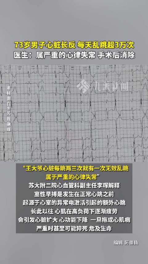#73岁大爷心脏长反每天乱跳3万次#【#医生谈大爷心脏长反每天乱跳3万次#：属严重的心律失常，手术后