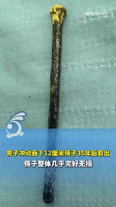 【#筷子在61岁男子胃里待了35年才发现#】#筷子体内待35年取出时基本完好#61岁汪先生26岁时因